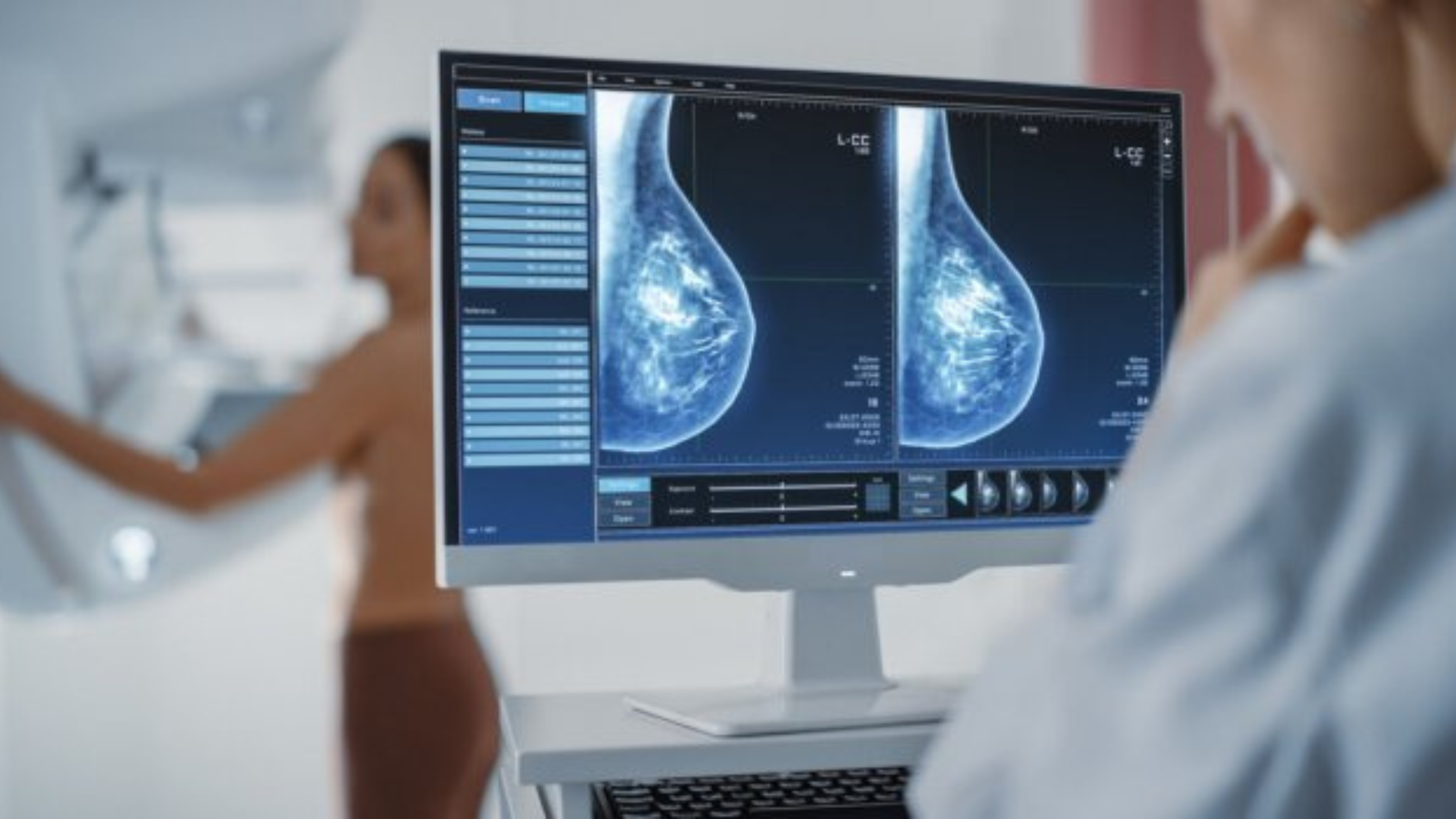 L'intelligence artificielle au service du dépistage du cancer du sein : une étude suédoise prometteuse