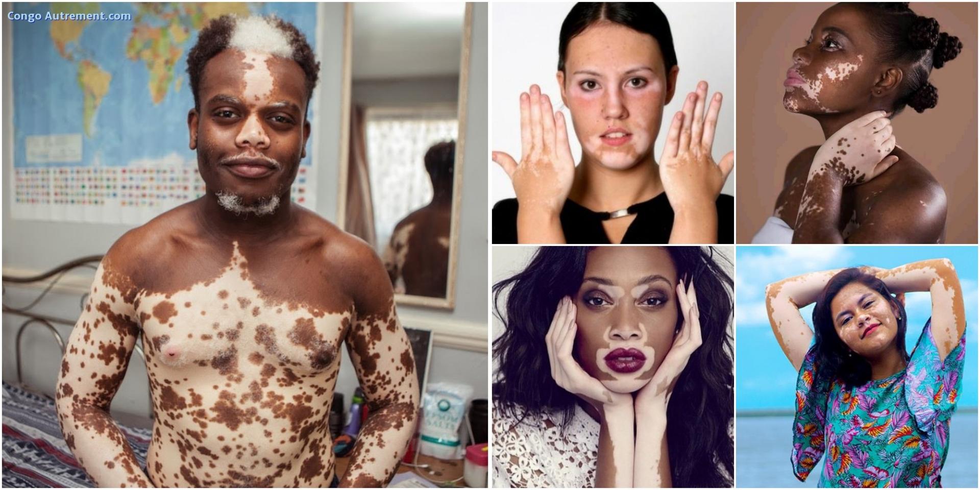 vitiligo